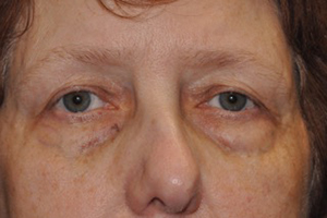 before lower eyelid lift