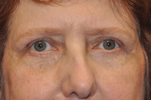 after lower eyelid lift