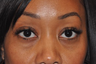 Lower Eyelid Lift or Blepharoplasty