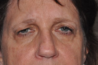 Forehead Lift Before & After Michigan