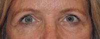 Upper Eyelid Lift or Blepharoplasty