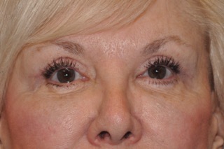 Upper Eyelid Lift or Blepharoplasty