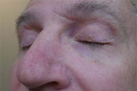 Eyelid Lesion
