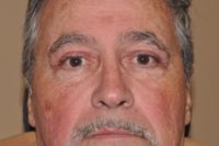 Droopy Upper Eyelids (Ptosis)