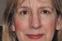 Droopy Upper Eyelids (Ptosis)