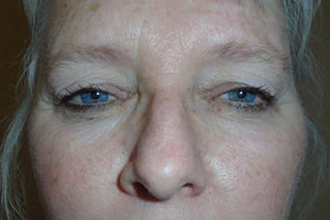 Upper Eyelid Lift or Blepharoplasty