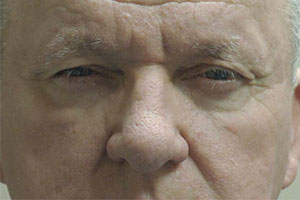 Upper Eyelid Lift or Blepharoplasty