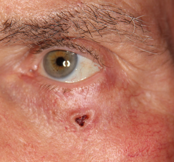 basal cell carcinoma