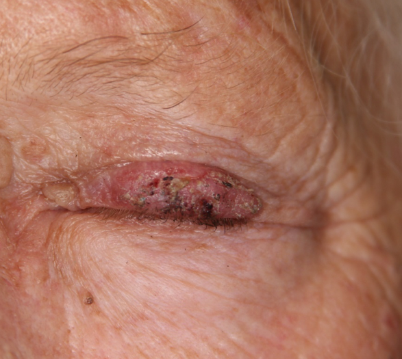 squamous cell carcinoma