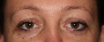 after eyelid retraction repair