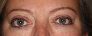 after orbital decompression surgery