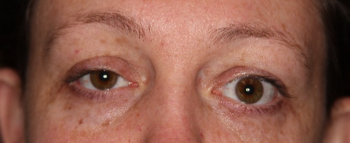 before eyelid retraction repair