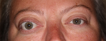 before orbital decompression surgery