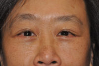 Lower Eyelid Lift or Blepharoplasty