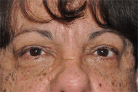 Eyelid Lesion