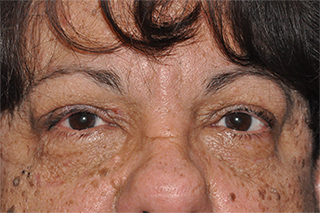 Eyelid Lesion