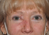 Eyelid Lesion