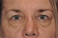 Lower Eyelid Lift or Blepharoplasty
