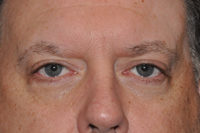Lower Eyelid Lift or Blepharoplasty