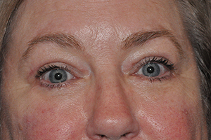 Droopy Upper Eyelids (Ptosis)
