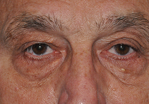 Upper Eyelid Lift or Blepharoplasty
