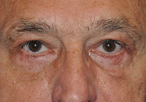Upper Eyelid Lift or Blepharoplasty