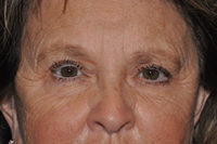 Droopy Upper Eyelids (Ptosis)