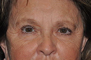 Droopy Upper Eyelids (Ptosis)