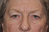 Droopy Upper Eyelids (Ptosis)