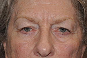 Droopy Upper Eyelids (Ptosis)