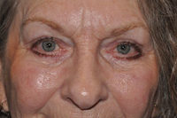 Droopy Upper Eyelids (Ptosis)