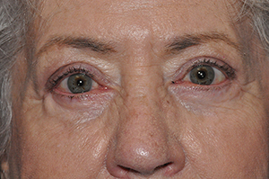 Droopy Upper Eyelids (Ptosis)
