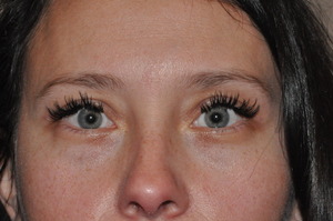 Droopy Upper Eyelids (Ptosis)