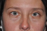 Droopy Upper Eyelids (Ptosis)