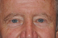 Droopy Upper Eyelids (Ptosis)
