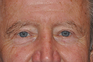 Upper Eyelid Lift or Blepharoplasty