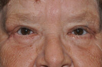 Droopy Upper Eyelids (Ptosis)