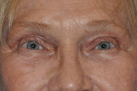Droopy Upper Eyelids (Ptosis)