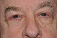 Droopy Upper Eyelids (Ptosis)