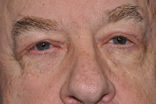 Droopy Upper Eyelids (Ptosis)
