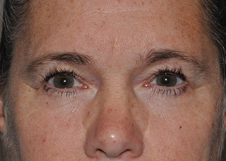 Upper Eyelid Lift or Blepharoplasty