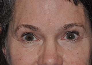 Upper Eyelid Lift or Blepharoplasty