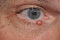 Eyelid Lesion