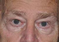 Droopy Upper Eyelids (Ptosis)