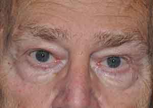 Droopy Upper Eyelids (Ptosis)