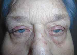 Droopy Upper Eyelids (Ptosis)