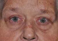 Droopy Upper Eyelids (Ptosis)