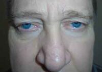 Droopy Upper Eyelids (Ptosis)