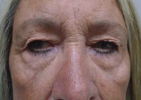 Upper Eyelid Lift or Blepharoplasty