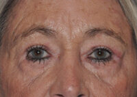 Upper Eyelid Lift or Blepharoplasty